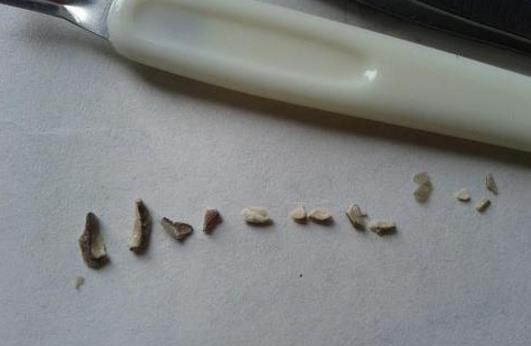 「肝脏」牙齿长出“小石头”，教你一个土方法祛除，不用花钱去洗牙