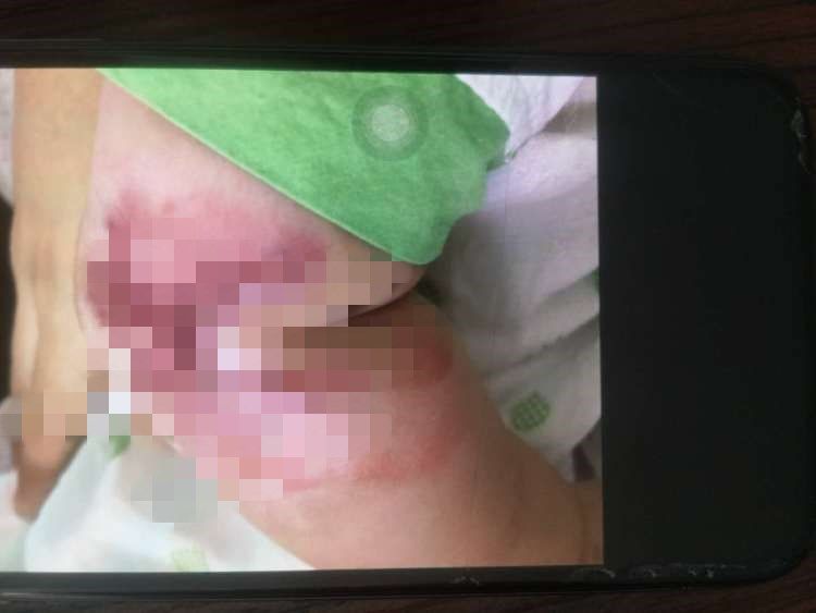 半岛都市报|心疼!出生3天男婴被护士烫伤,愁人!父母欲出国治疗犯难