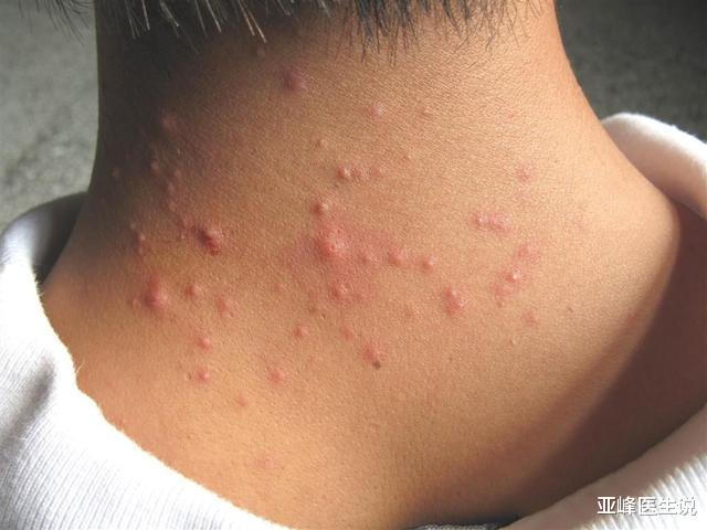 肿瘤|脖子上为何会出现小肉粒?对身体有伤害吗?若是这两种就要注意