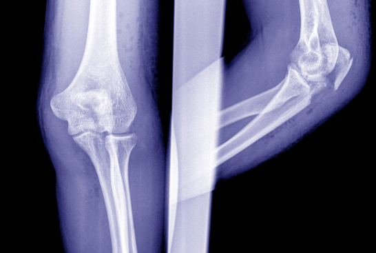 骨质疏松|骨头松最怕这种“水”，不是牛奶，饭后喝一杯，让你的骨骼邦邦硬