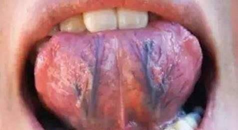 芒刺▲舌头下面的青筋为何会凸起？是身体出问题了？或是这两个问题作怪