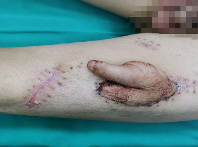 违章建筑▲医生妙想创奇迹！把烧伤患者截掉的左拇指“寄养”在大腿上