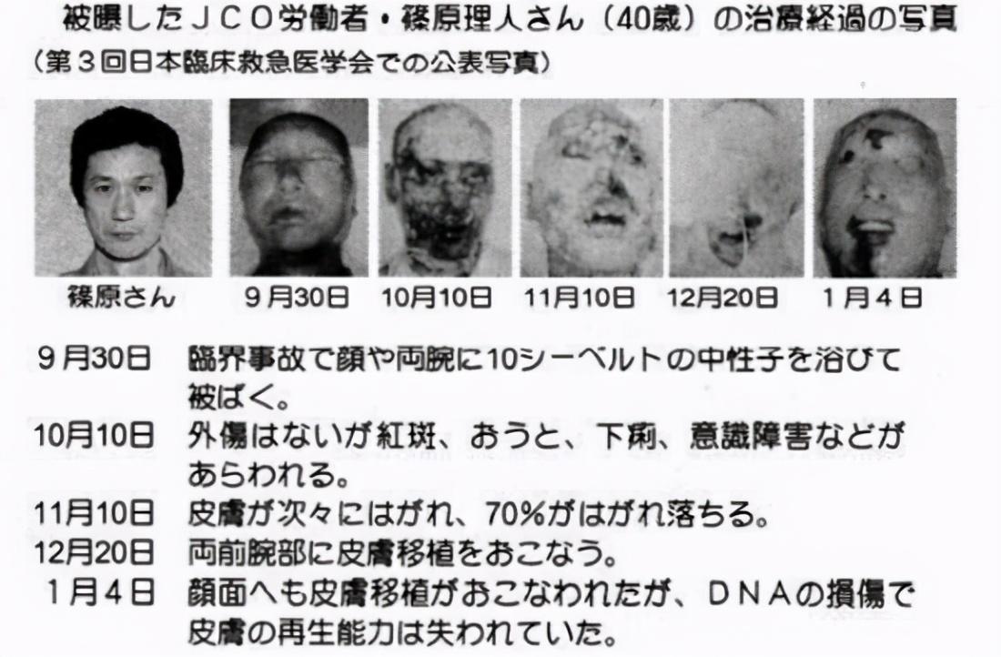 |全身DNA断裂会发生什么？全球仅有一例的惨剧，看完脊背发凉