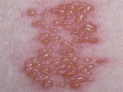 [皮肤病]皮肤科主任：这3种皮肤病无法治愈，说能根治的都是骗子