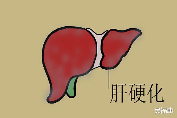 肝硬化：肝硬化并非突然来袭，身体早有预兆，及时发现，或许能避免癌变