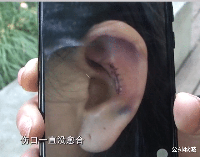 公孙秋波 做隆鼻失败后，女子索赔十余万遭拒，医院：她是想“敲”一笔钱