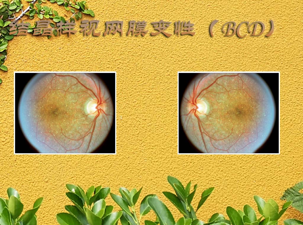 【基因突变】万分之一的你因基因突变而特别，在结晶样视网膜色素变性疾病中翘首等待