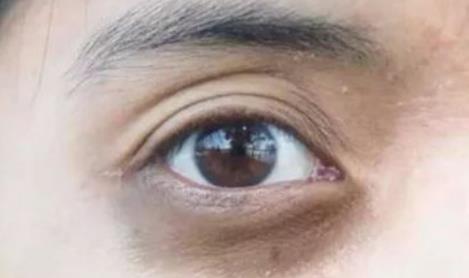 肝脏|身体3个部位发黑，可能是肝病来临，一个不占，恭喜你肝很健康