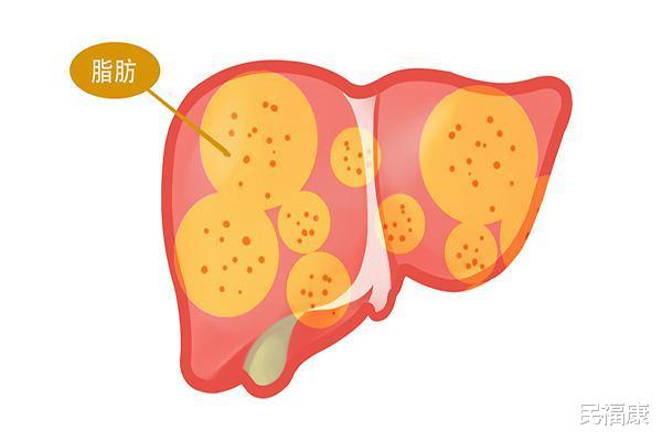 「高血脂」熬夜有多伤肝？经常熬夜的人，尝到的后果，或是你难以承受的