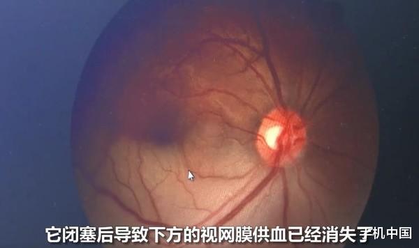 小米科技|看完之后不敢熬夜系列 31岁男子熬夜看手机致眼中风