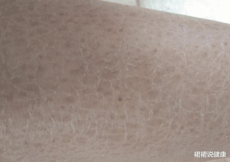 []小腿上长“鳞片”，脚后跟“开裂”，多数人还以为是缺水，治出麻烦