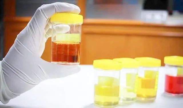 肝脏▲爱喝酒的人，身上出现4个信号，预示肝脏已受损，得戒酒了！