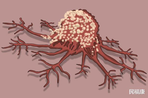 医生|医生提醒大家，得了癌症，皮肤是会给出信号的，4点异常较为明显