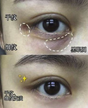 「眼霜」药房有一种“平价”眼霜,堪称眼袋眼纹的“天敌”,却因廉价被嫌弃