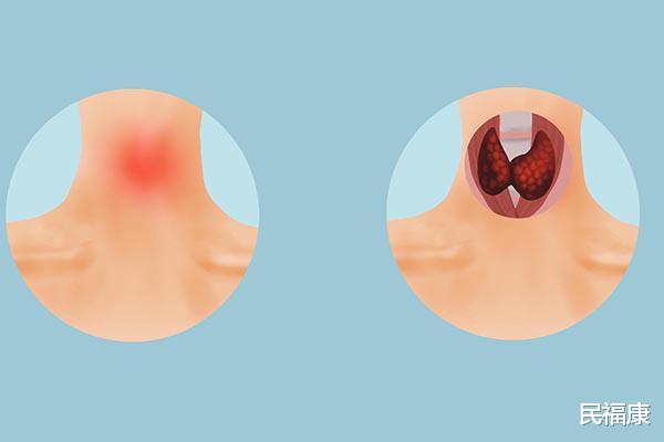 「糖尿病」甲状腺结节能不能自愈？学会了吃，结节或能主动消失