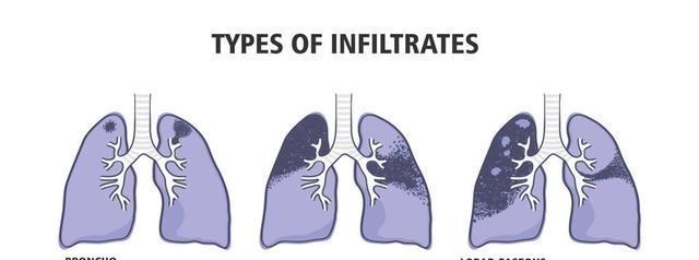 戒烟|烟瘾大的人，若上半身有4个异常，希望你趁早戒烟，别不听劝