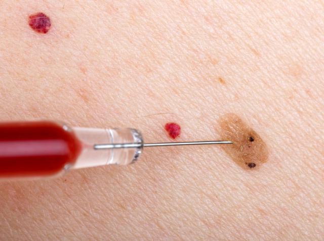 『营养膳食』身体突然出现这5种痣，当心是癌变发出的信号，希望你没有