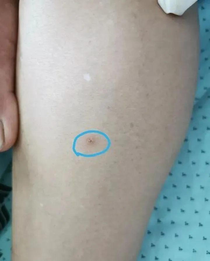 浙样的生活|女子因虫子发热一周，这虫子还有来历，别来无恙的“恙”指的是它