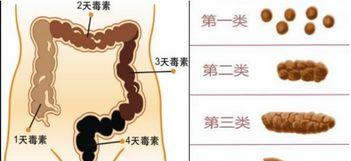 便秘▲人体内真有6公斤的宿便?该如何清除这些宿便?建议试试这4个方法