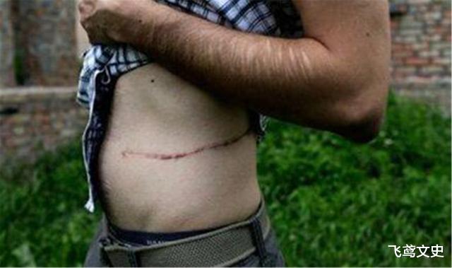 医生|尼泊尔有处“肾谷”，男人靠卖肾发家致富，几乎人人身上都有伤疤