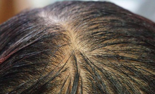 #脱发#男性出现脱发现象的原因是那些？