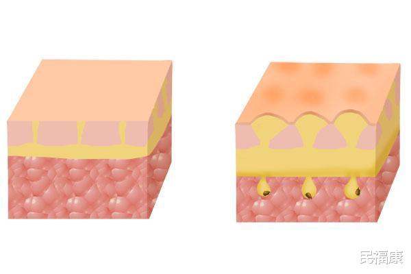 血管瘤▲刚过四十岁，为啥就有老人臭？原因很简单，现在就改，老了也没味