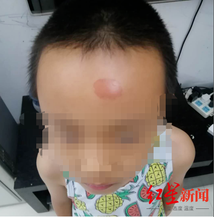 联合国|一小学上百名学生被紫外线灯灼伤，有家长称出现眼角膜脱落