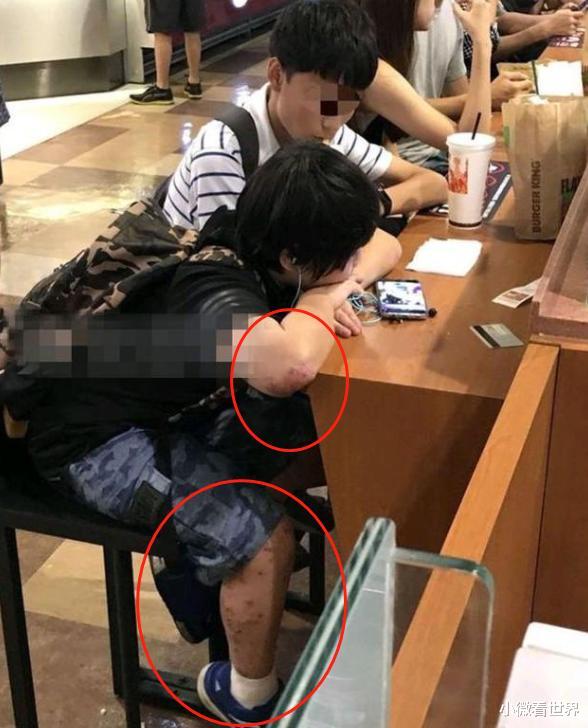 「小小彬」他给亲爸买豪宅, 赚钱给后妈整容, 皮肤溃烂却遭袖手旁观, 今怎样了