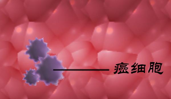 #癌细胞#出现这3种疾病,或是在“提醒”你,体内可能有癌细胞了