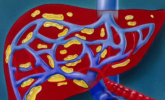肝脏|30岁男子误认为肩周炎,查出肝硬化,医生叹息:无知的妻子害了他