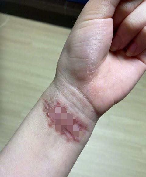 [权珉阿]韩前女团成员自曝遭队友霸凌！受欺负长达10年，晒割腕照触目惊心