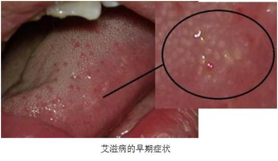 「」关于艾滋病的一些问题解答，艾滋究竟离我们有多远？