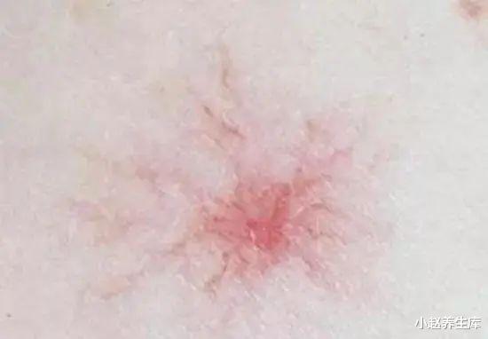 肝脏▲28岁女子，查出肝癌，告诫：常吃一种“毒物”，肝脏早已癌变