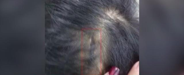 『河源』女童惨遭生母殴打入院，医生：再晚将危及生命！