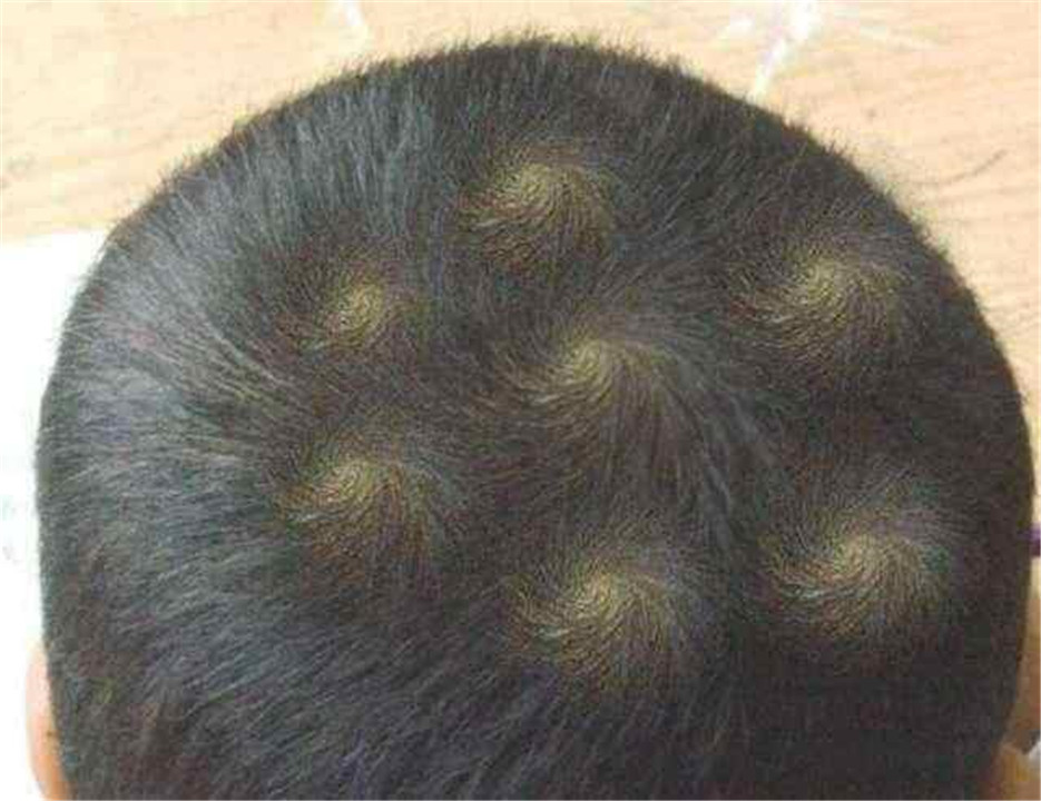 基因▲孩子头顶“发旋”越多，脾气就越不好？不妨抛开迷信看看科学解释