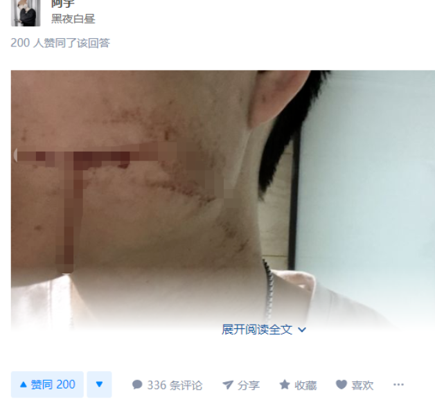 医生▲26岁男拔完智齿，连续喷血10天死亡，医生：他全身血都是细菌