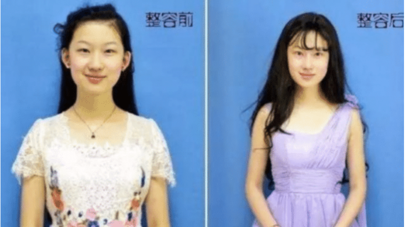 整容|19岁就花百万要整容成刘亦菲,名字也像仿刘亦菲,现23岁成这样