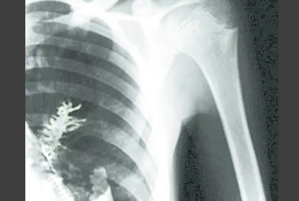 肺癌：俄罗斯小伙被确诊为肺癌，手术时，医生在其肺中发现一棵冷杉树