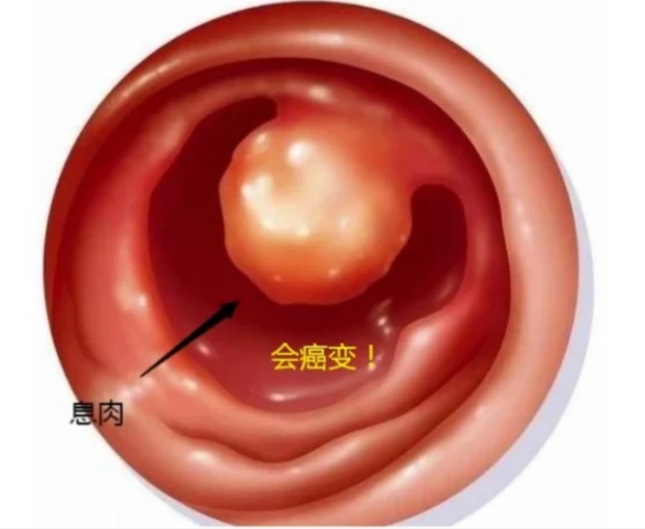 肠息肉|肠息肉：上厕所时通常会出现3个现象, 希望你一个也不占!