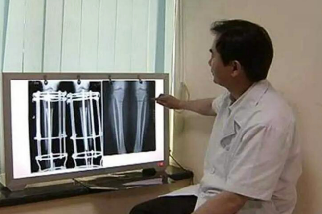 上海地铁|20岁小伙因身高自卑，花16万断骨增高7厘米，后来怎样了？