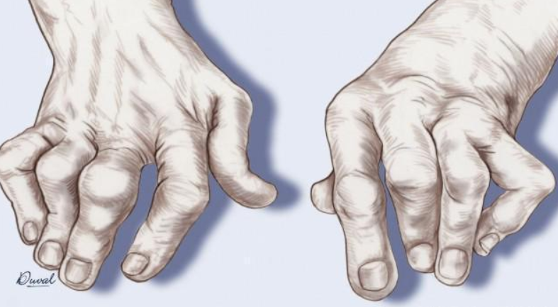 尿酸|医生告诫:这4物是“升酸王”,不想双肾报废,再馋也要管住嘴