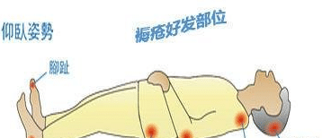 历史揭秘|为啥古代只要长了“背疽”就会死人“背疽”是啥病