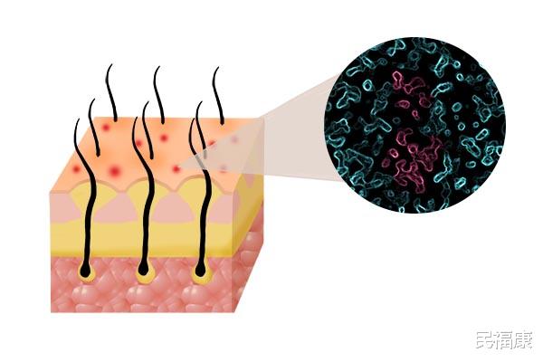 #毛囊炎#头皮上总出油，长有疙瘩或脓包，也许藏着病！越早发现越好
