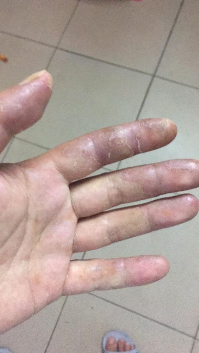 |望大V能够分享一下|真实经历分享#钓鱼人#职业病之香虎手治疗方案