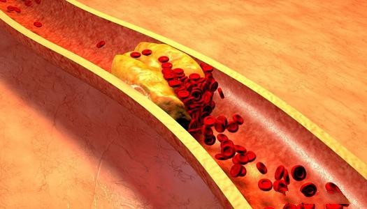 胆固醇|高血脂不能吃什么？高血脂不吃药能不能恢复正常？医生说明！