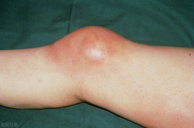 滑膜炎|医生：一把花椒巧治滑膜炎，不到半月，膝盖不疼了，积液也消失了