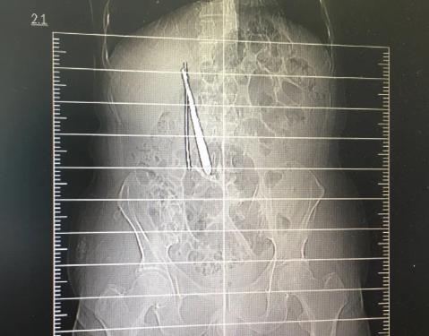 【湖北】郑州男子腹痛难忍，检查发现肠子里有3根近15厘米长金属条，咋回事？