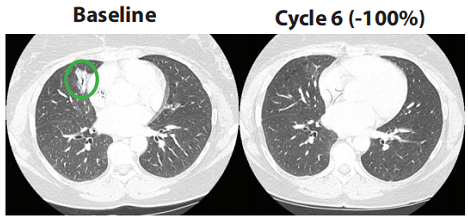 欧洲|又刷屏！新药物针对ALK/ROS1/NTRK多种突变癌症有效