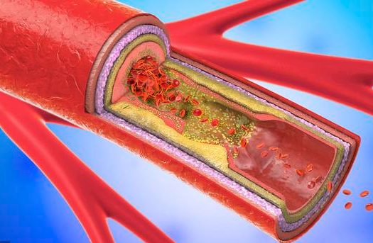 脑出血■脑出血不是突然到来,身体的七个信号,出现2个以上,尽早就医