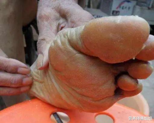 「肝脏」肝不好的人，脚底会出现4个迹象，占1个，也要去查查肝